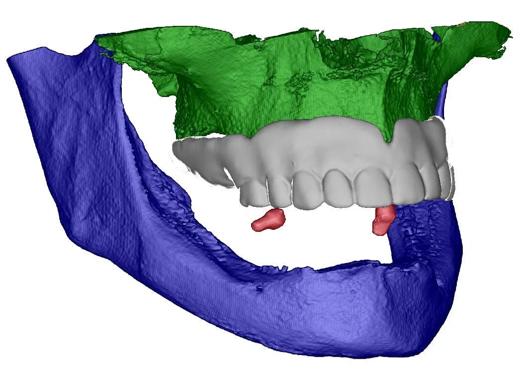 Röntgenkugeln aus bariumsulfathaltigem Kunststoff für CT, DVT (7)