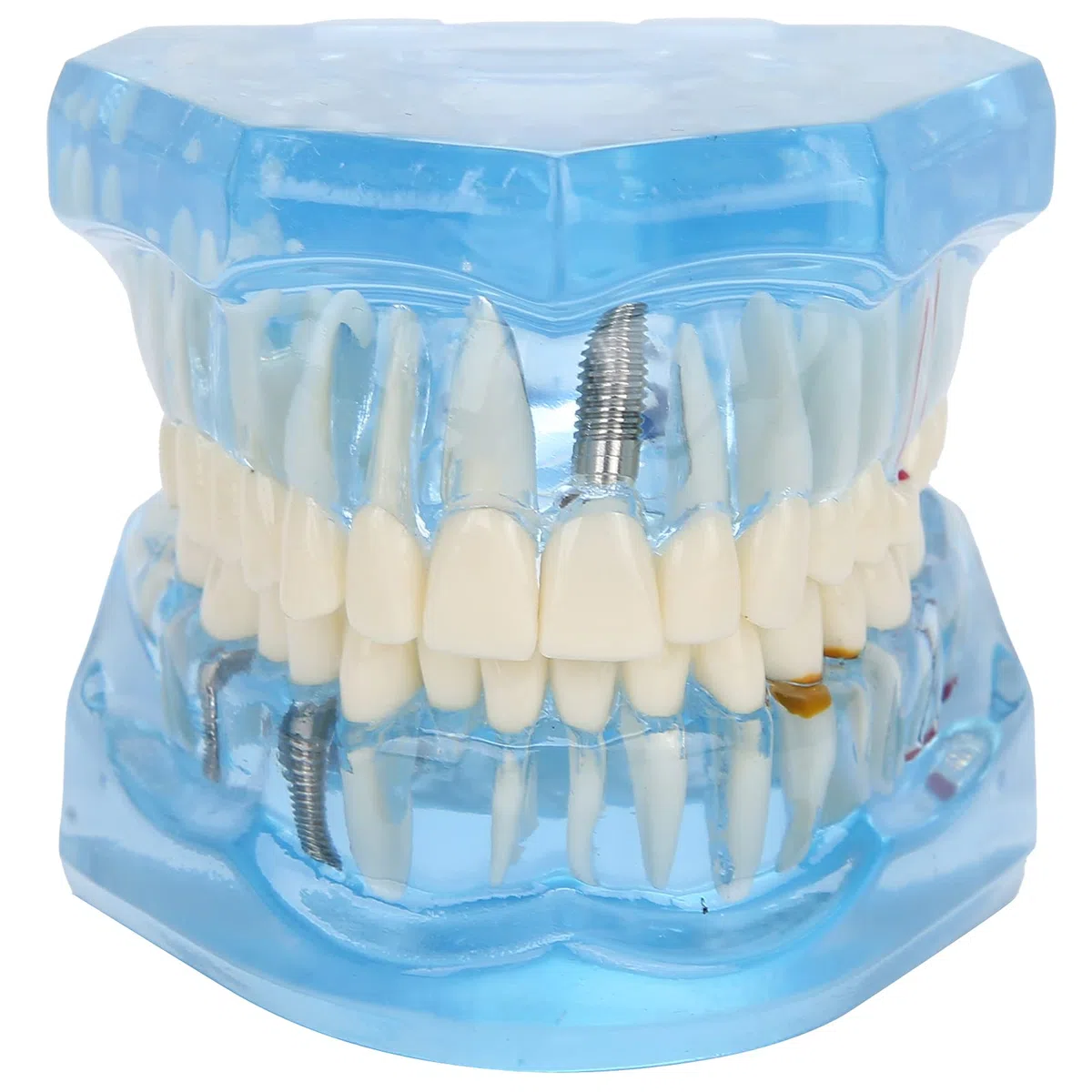 Zahnärztliches Oral-Typodont-Modell, Acryl-Blau-Zahnmodelle, Transparentes Mundmodell, Zahnmodell, Kompatibel Für Zahnmedizinisches Studium, Lehre, Forschung